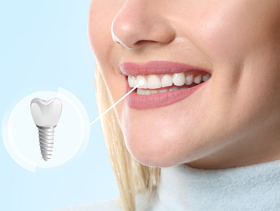 The image shows a close-up of a smiling woman with an orthodontic appliance, likely a clear aligner, on her teeth, which has a toothpick inserted into one of its attachments.