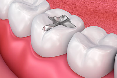 The image shows a close-up of a human mouth with teeth and a silver filling.
