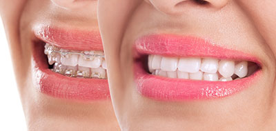 The image features a woman s face with two versions of her smile  one natural and one enhanced by cosmetic dental work, creating a visual comparison between the two.