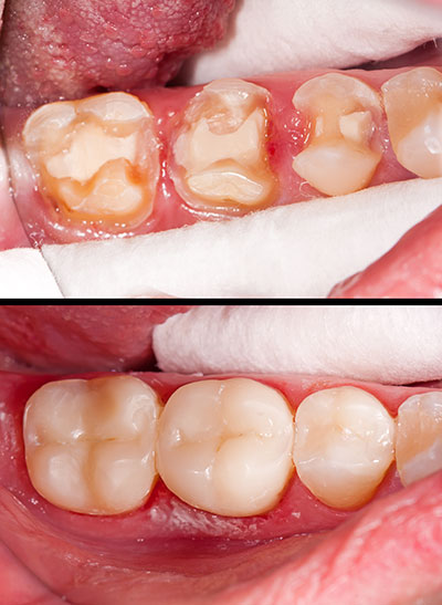The image shows a close-up view of a person s mouth with teeth that appear to be in poor condition, possibly due to neglect or disease, with some areas showing decay or cavities. There are two panels  one showing an open mouth with visible damage and the other a close-up of the same mouth with a focus on the teeth.