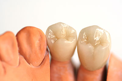 The image shows a set of artificial teeth with varying levels of wear and tear, placed on a white background.