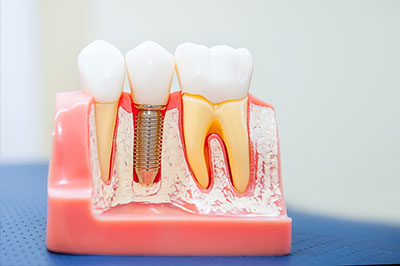 Alt text   A plastic model of a human mouth with teeth and gums, featuring dental implants and a screw holding them in place.