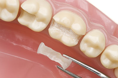 An open mouth dental model with a tooth missing, showcasing a filling material being placed into the cavity.