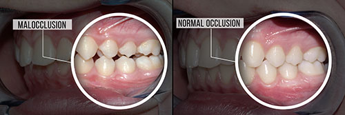 The image shows a before-and-after comparison of a dental implant procedure, with the  before  side showing a toothless gap and the  after  side displaying a fully restored smile with a new tooth in place.