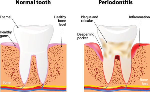 The image displays two stages of gum disease progression labeled  Normal tooth  and  Periodontitis,  with a cross-sectional view showing bone loss around teeth, an inflamed gumline, and a healthy gumline.