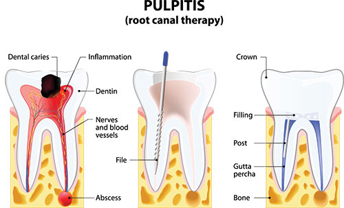 The image displays a diagrammatic illustration of a pulpitis tooth with annotations indicating dental caries, inflammation, and a crown. It also shows a cross-sectional view of a tooth with various tissues and structures labeled, including dentin, enamel, and nerves.