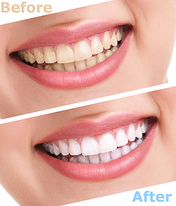 The image shows a side-by-side comparison of a person s teeth before and after dental treatment, with a focus on teeth whitening.