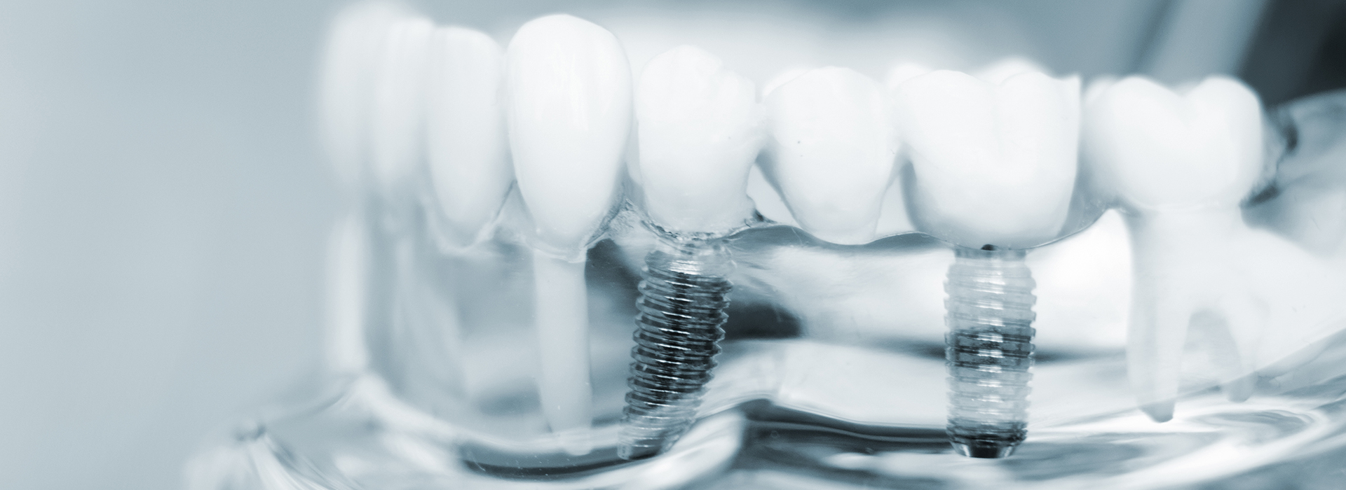 The image shows a close-up view of several dental implants with screws visible against a blurred background, likely taken from above a dental tray.