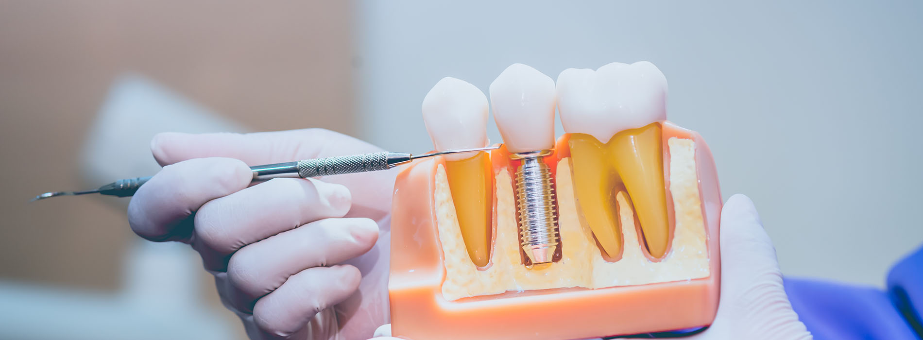 The image shows a person holding a dental impression tray with a toothbrush inside it, likely preparing for a dental appointment.