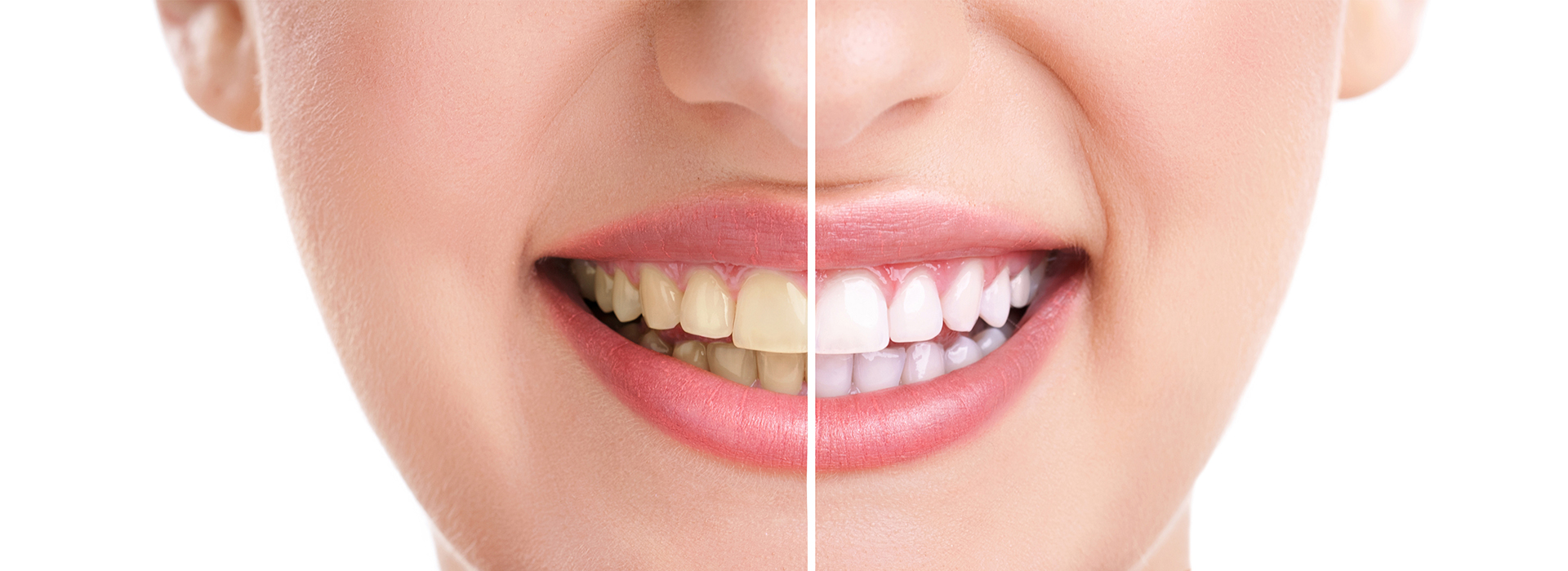 The image shows a close-up of a person s face with their teeth being straightened or whitened, emphasizing dental care or cosmetic services.